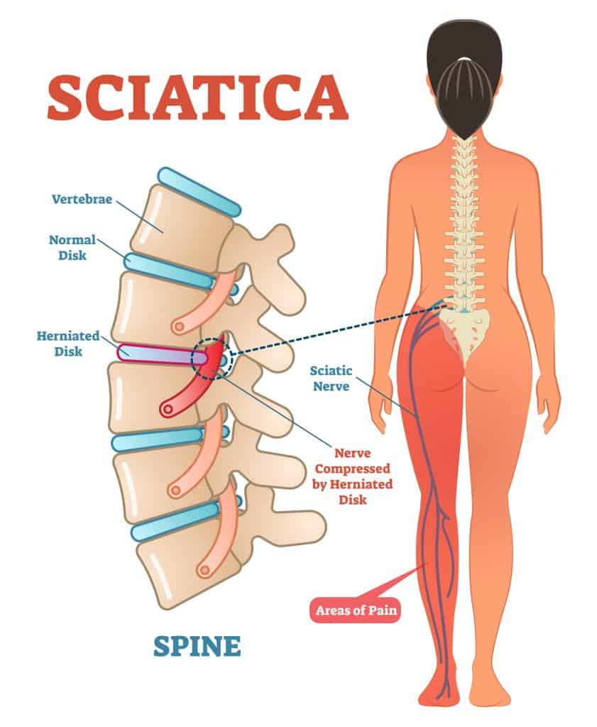 cartoon image of the spine and sciatica - education for article is ice or heat better for sciatica