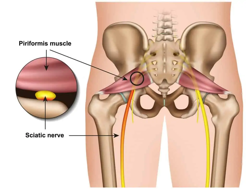 cartoon image of the sciatic nerve and piriformis syndrome