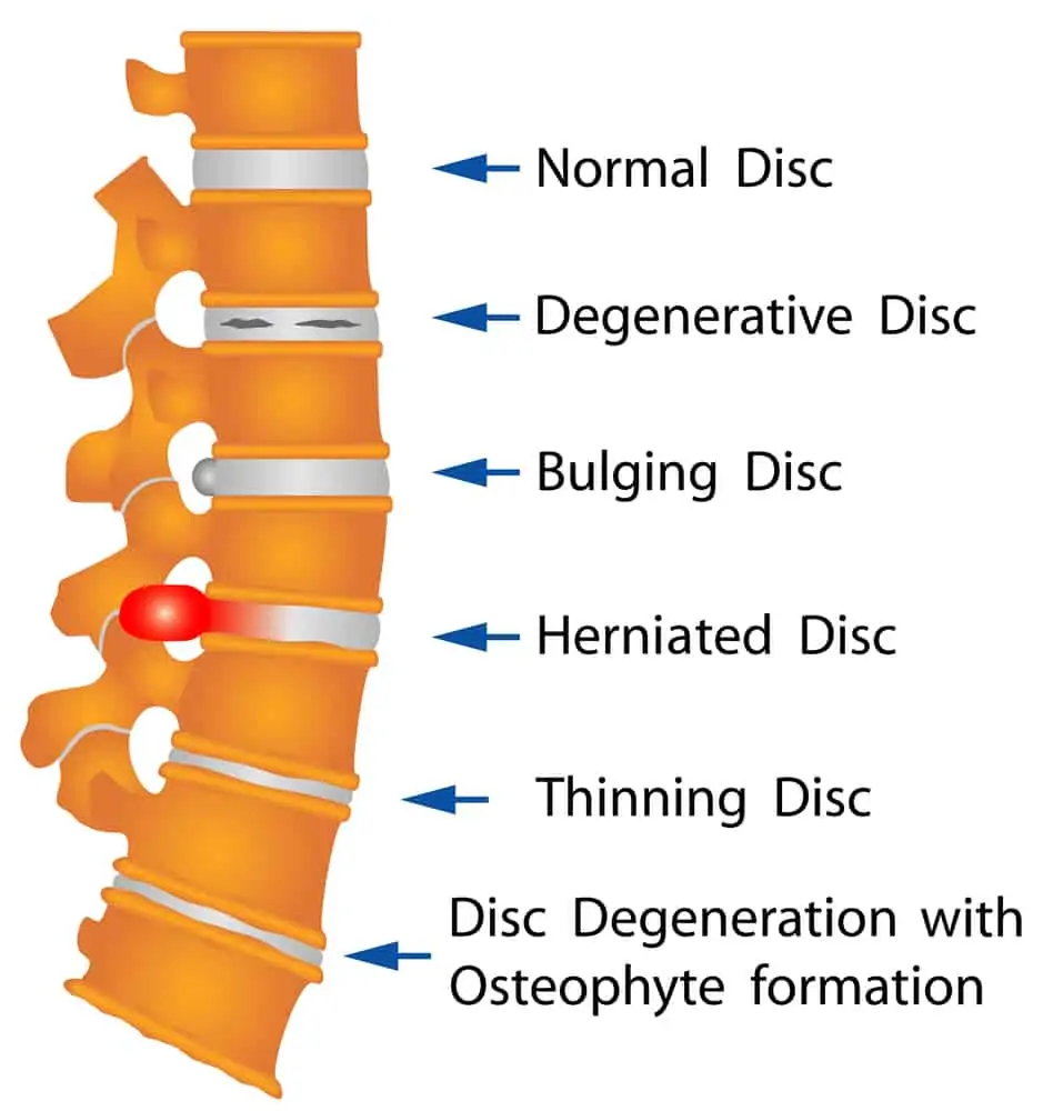 illustrating of different types of spinal disc injuries