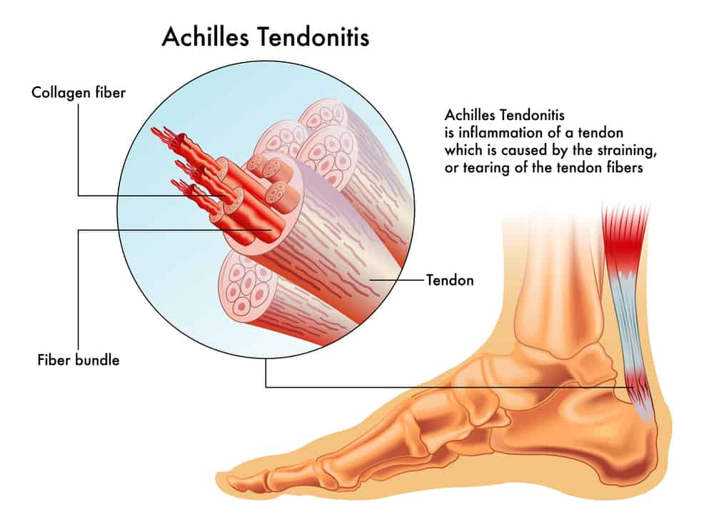 vector image of achilles tendonitis
