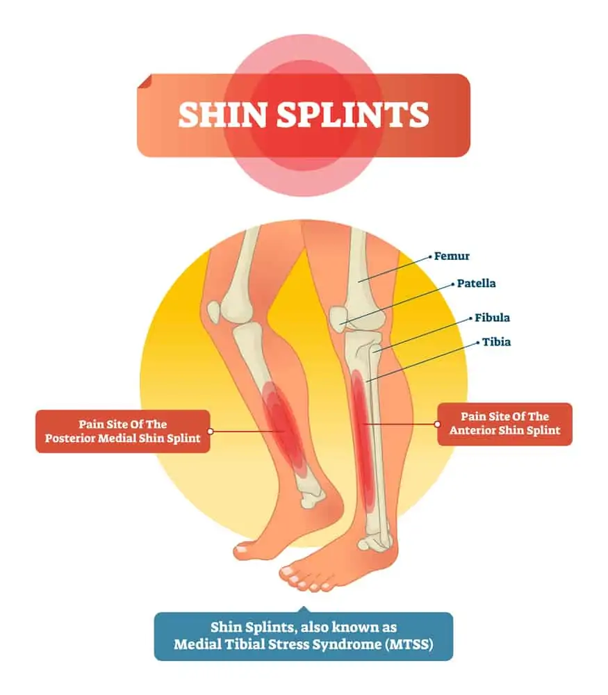 vector image of shin splints