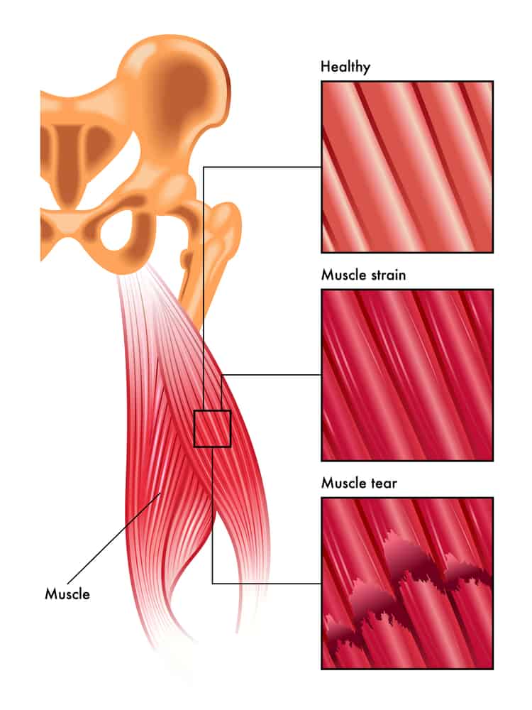 vector image of a muscle strain