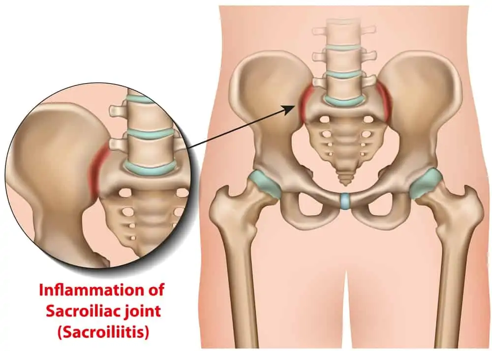 what aggravates sacroiliac joint pain