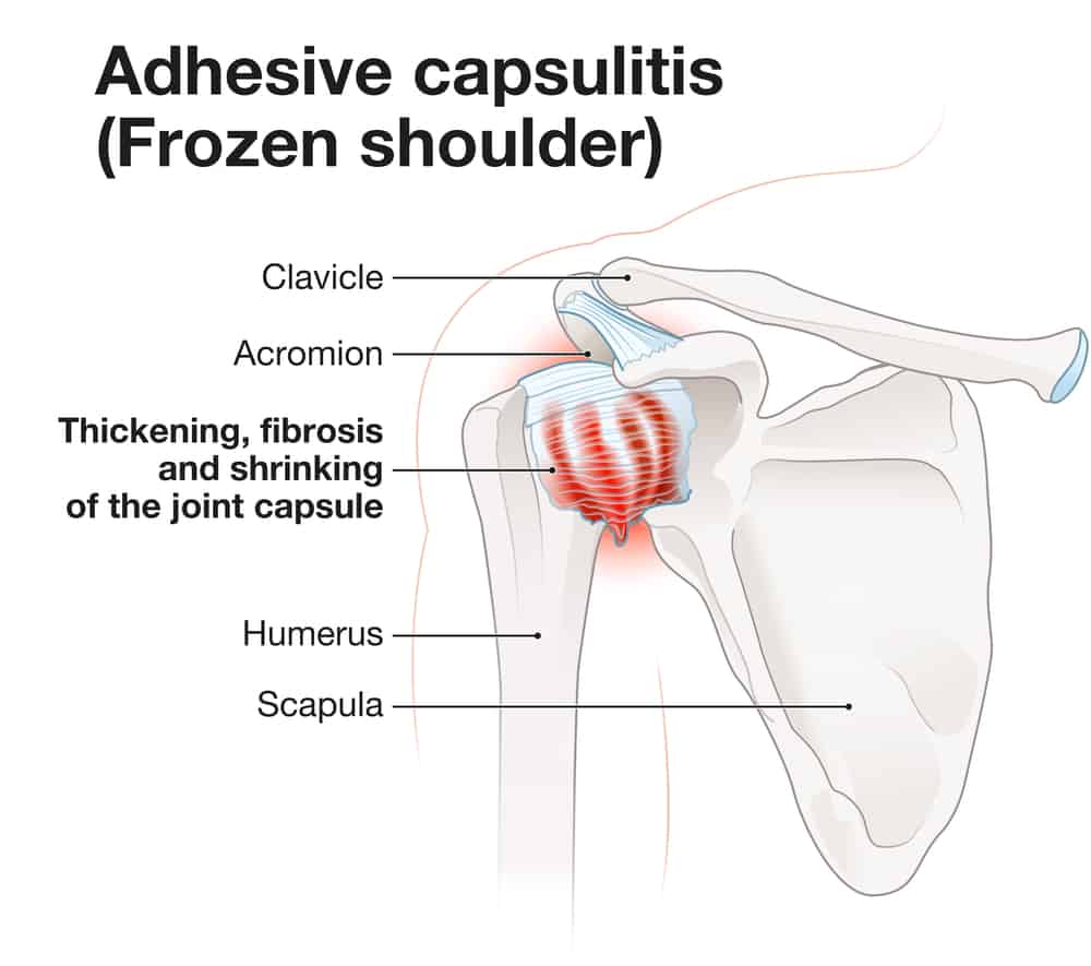 graphic of frozen shoulder - shoulder impingement vs. frozen shoulder