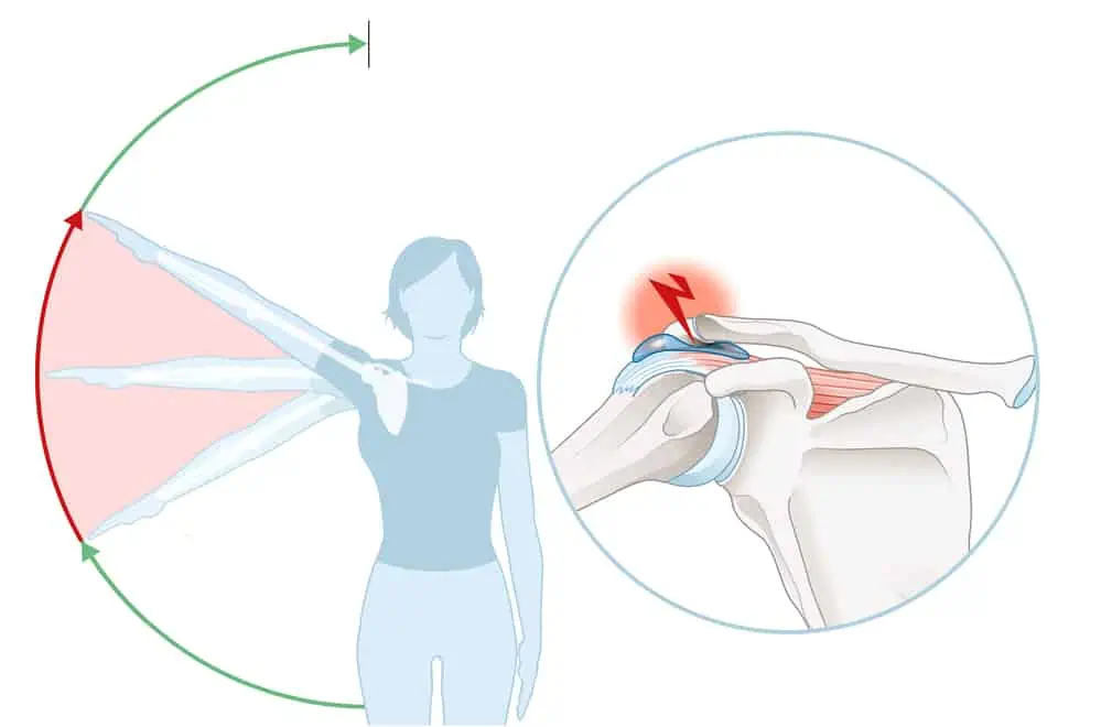 graphic demonstrating a painful arc with shoulder impingement - how to relieve rotator cuff pain at night