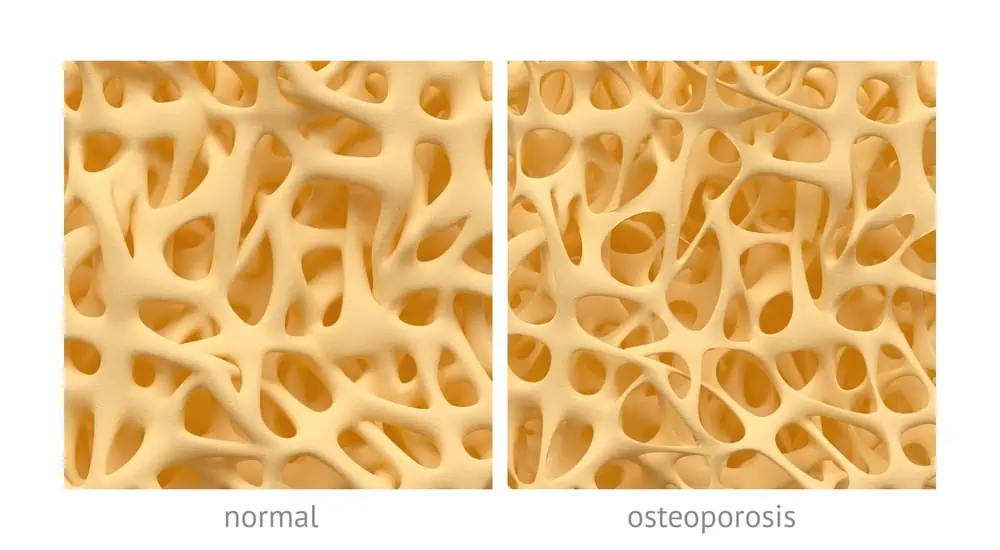 image of normal bone tissue vs. osteoporosis