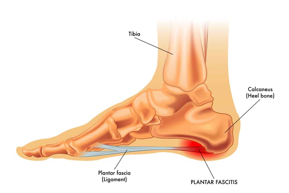 Plantar Fasciitis vs. Achilles Tendonitis How To Tell The Difference