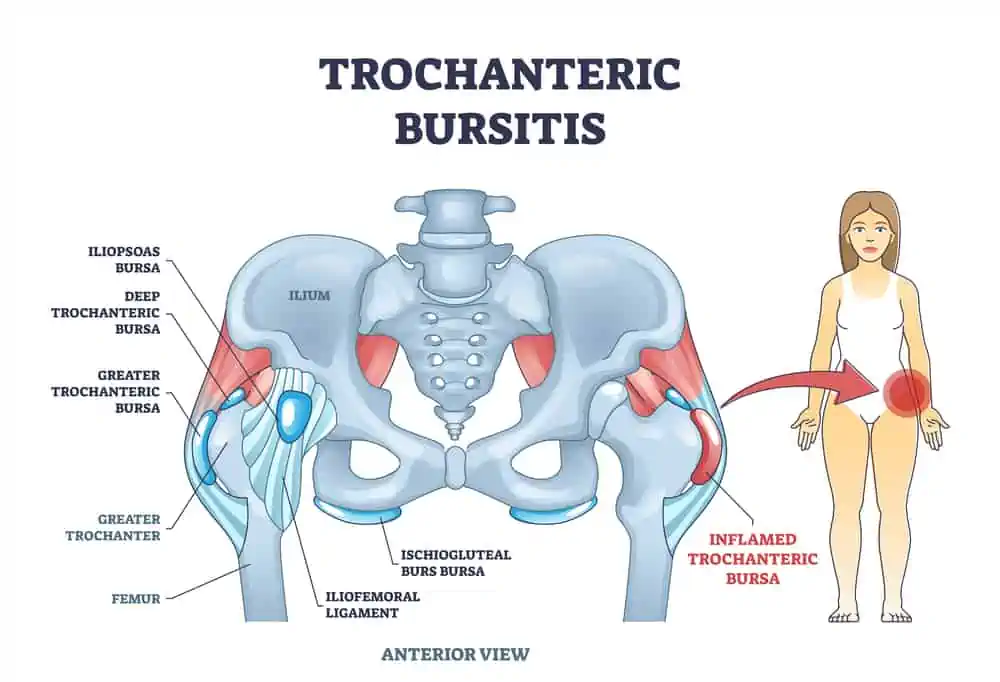medical graphic of trochanteric bursitis