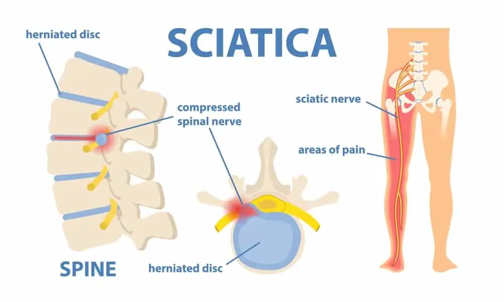 anatomy picture of sciatica - signs of sciatica improving